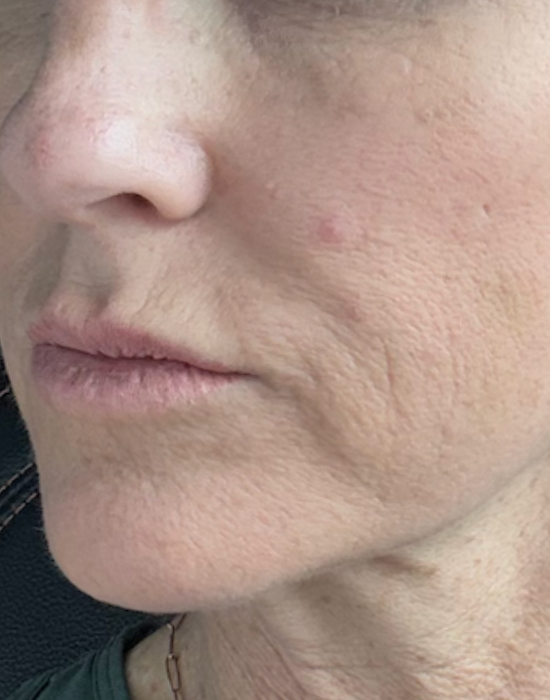 Before_and_After_Dermal_Filler_to_Marionettes_and_Cheeks