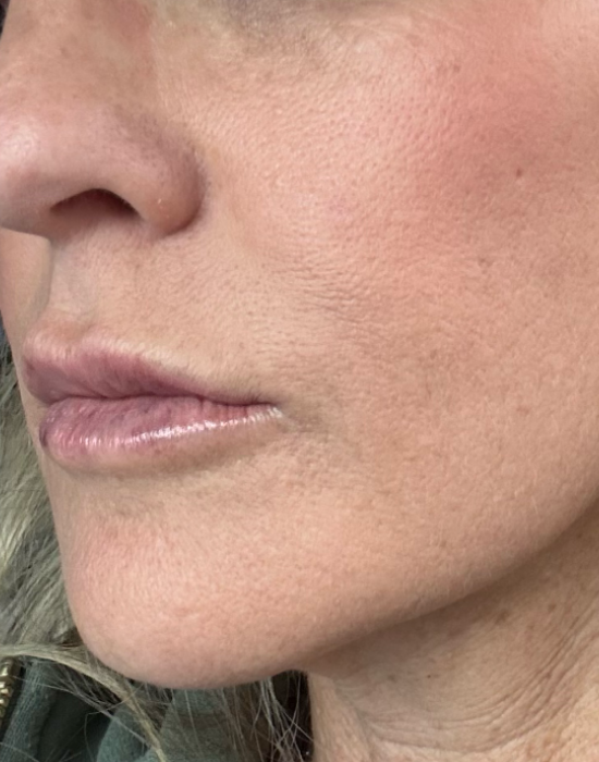 Before_and_After_Dermal_Filler_to_Marionettes_and_Cheeks_2